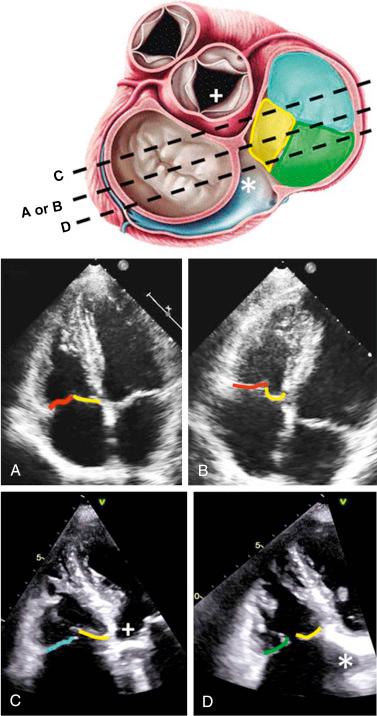 Fig. 57.6, Transesophageal echocardiographic apical four-chamber views.