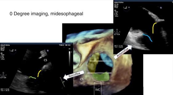 Fig. 57.8, (Central panel) Three-dimensionally reconstructed en face view of the tricuspid valve (TV). Left and right panels: Two-dimensional transesophageal echocardiographic (TEE) views of the TV leaflets. During screening TEE, it can be difficult to ascertain which of the TV leaflets is being imaged. One solution is to start neutral in the midesophageal view and advance until the TV leaflets are encountered. A slight anteroflexion or retraction will bring the aortic valve in and out of view, confirming that the TV leaflets being images are the septal (yellow) and anterior (blue) leaflets (right panel) . Conversely, the TEE probe can be retroflexed; as the CS comes in/out of view, this confirms that the septal (yellow) and posterior leaflets (green) are being imaged (left panel) . CS , Coronary sinus; IVC, inferior vena cava; TEE , transesophageal echocardiography; TV , tricuspid valve.