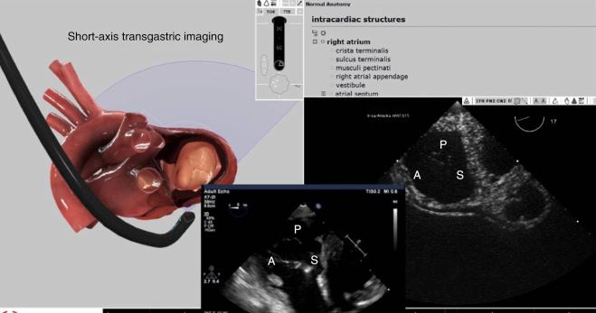 Fig. 57.9, Simulated images show positioning of the TEE probe and the imaging plane being acquired on the left panel. The simulated transgastric plane being acquired is shown on the right panel. An example from a recent patient is shown in the bottom inset, where all three commissures are identified. A , Anterior; P , posterior; S , septal.