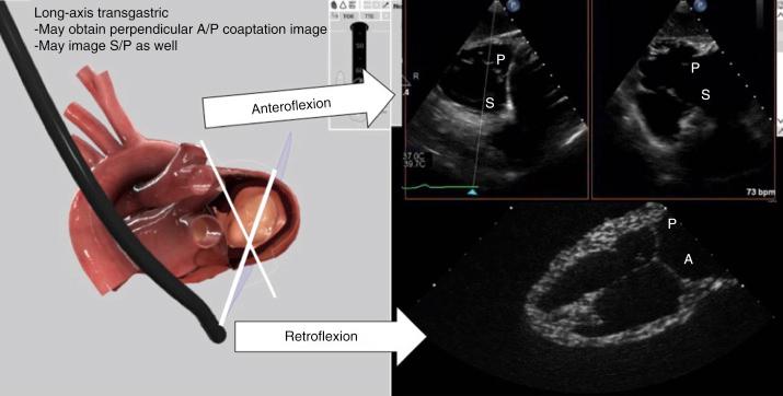 Fig. 57.10, Simulated transesophageal echocardiographic (TEE) positioning and images of the long-axis transgastric views are shown in the left panel. Generally once image acquisition has been achieved, a slight retroflextion will enable visualization of the anterior and posterior leaflets (bottom right panel) . Anteroflexion and slight retraction of the TEE probe at this point can enable visualization of the septal and anterior leaflets. A , Anterior; P , posterior; S , septal.