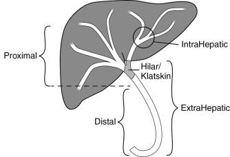 Figure 11-1, Terminology associated with the location of cholangiocarcinoma. Hilar cholangiocarcinoma (Klatskin tumor) is further classified according to the Bismuth-Colette classification (see Figure 11-2 ).