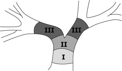 Figure 11-2, Bismuth classification. Bismuth-Corlette Type I: Tumor is in the common hepatic duct and does not involve the confluence of the right and left main biliary ducts. Bismuth-Corlette Type II: Tumor is at the confluence of the right and left main biliary ducts. Bismuth-Corlette Type III: Tumor is at the confluence of the right and left main biliary ducts and extends to one of the second-order confluences: either right or left. Bismuth-Corlette Type IV (not drawn): Tumor is at the confluence of the right and left main biliary ducts and extends to both of the second-order confluences: right and left.