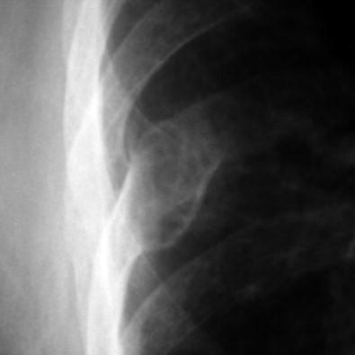 Percutaneous musculoskeletal biopsy – Clinical Tree