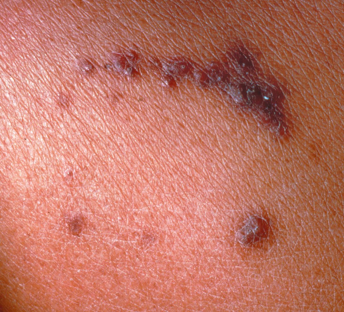 Fig. 79.3, Acquired perforating dermatosis.