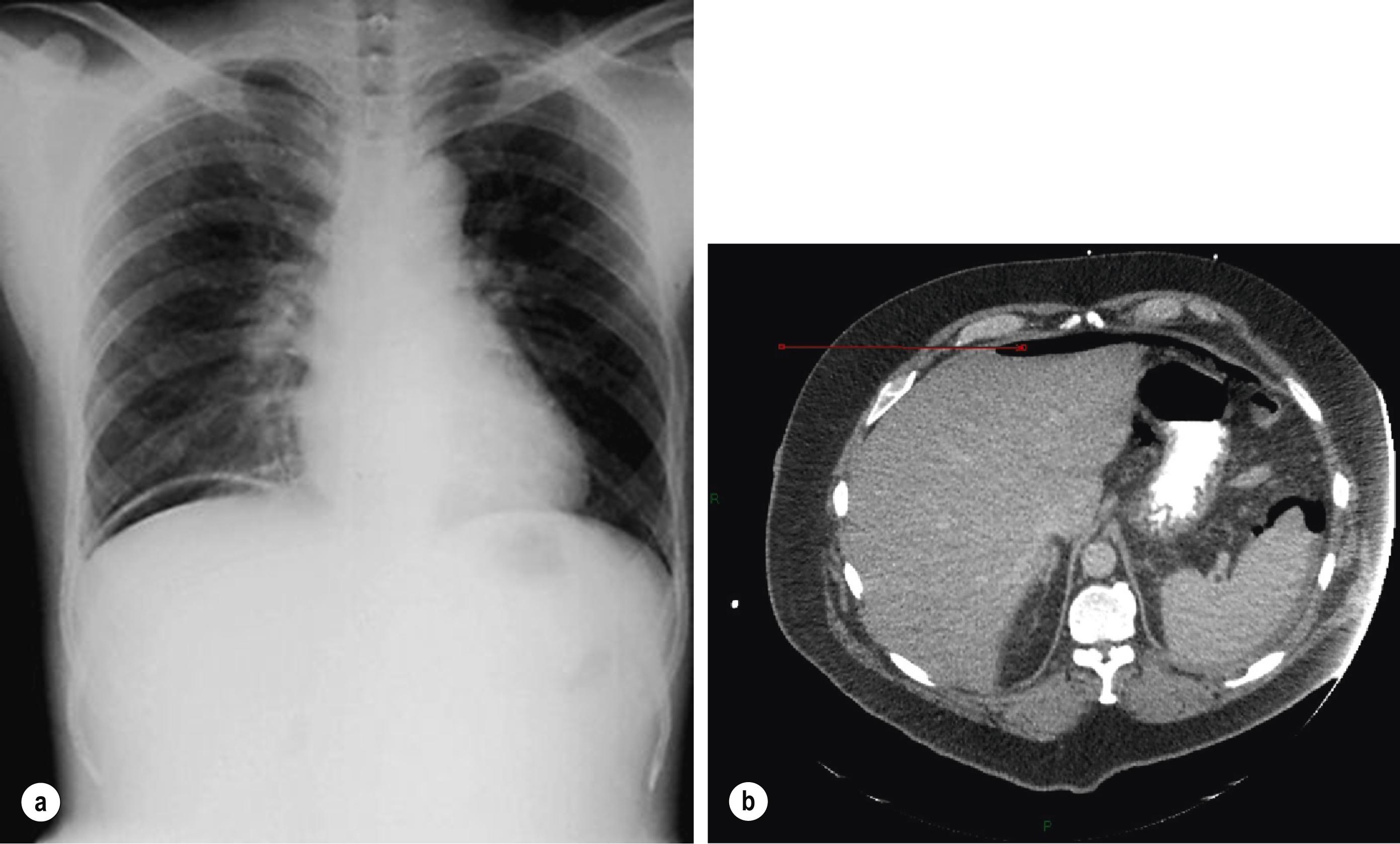 Figure 12.1, (a) Chest X-ray demonstrating right subphrenic free gas secondary to a perforated peptic ulcer. (b) Transverse section of an abdominal computed tomography scan demonstrating free intraperitoneal gas ( arrow ) in a patient presenting with a perforated peptic ulcer with normal erect chest X-ray appearances.
