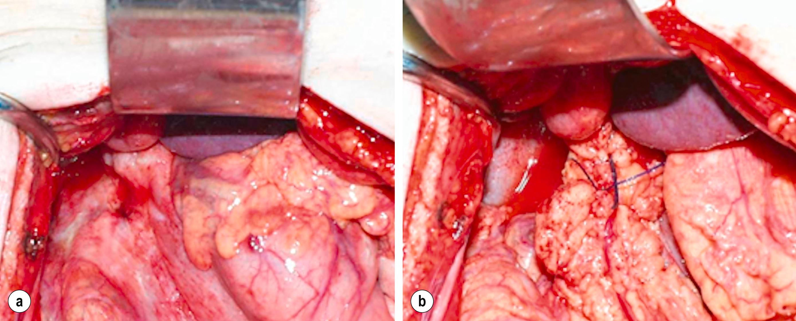 Figure 12.2, (a) A small perforation at the juxtapyloric area. (b) Pedicle omental patch repair on the perforation site secured with absorbable sutures.