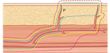 Figure 56.4, The concept of the flap based on its pedicle started from the arterial-based concept (red dashed line), advanced to the branch-based concept (yellow line), and finally to the perforator-based concept (blue dashed line) with which the tissues can be taken very selectively. P, perforator.