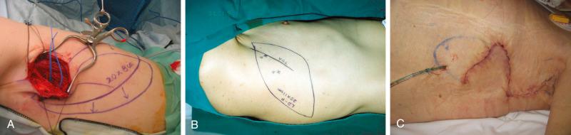 Figure 56.6, (A) The flap design can be modified during the operation according to the perforator selected. (B) The usual oblique elliptical design according to the relaxed skin tension by pinch grasp. (Note that this is a different patient.) (C) The donor defect is closed primarily with a local transposition flap.