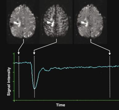 Figure 28.1, Acquisition of dynamic susceptibility contrast perfusion magnetic resonance imaging.