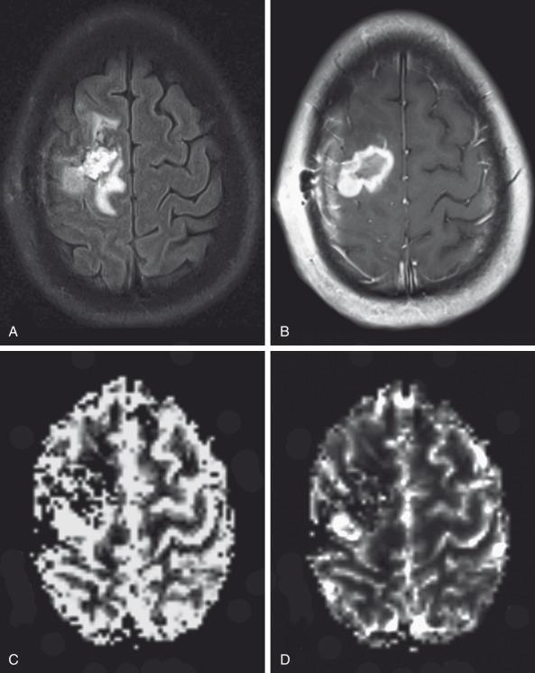 e-Figure 28.2, Perfusion MRI in a 17-year-old patient with an anaplastic astrocytoma a few months after surgical resection and chemoradiation therapy.