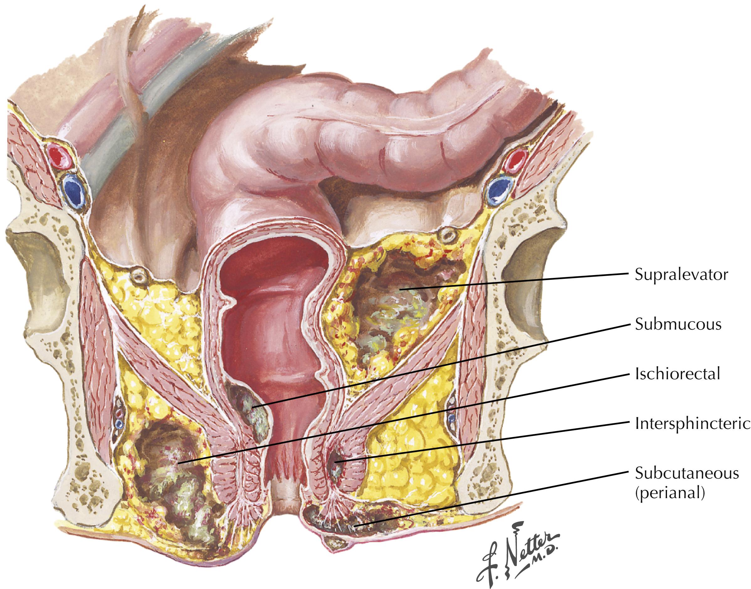 FIGURE 33.2, Spaces around the rectum and anus where abscesses develop.