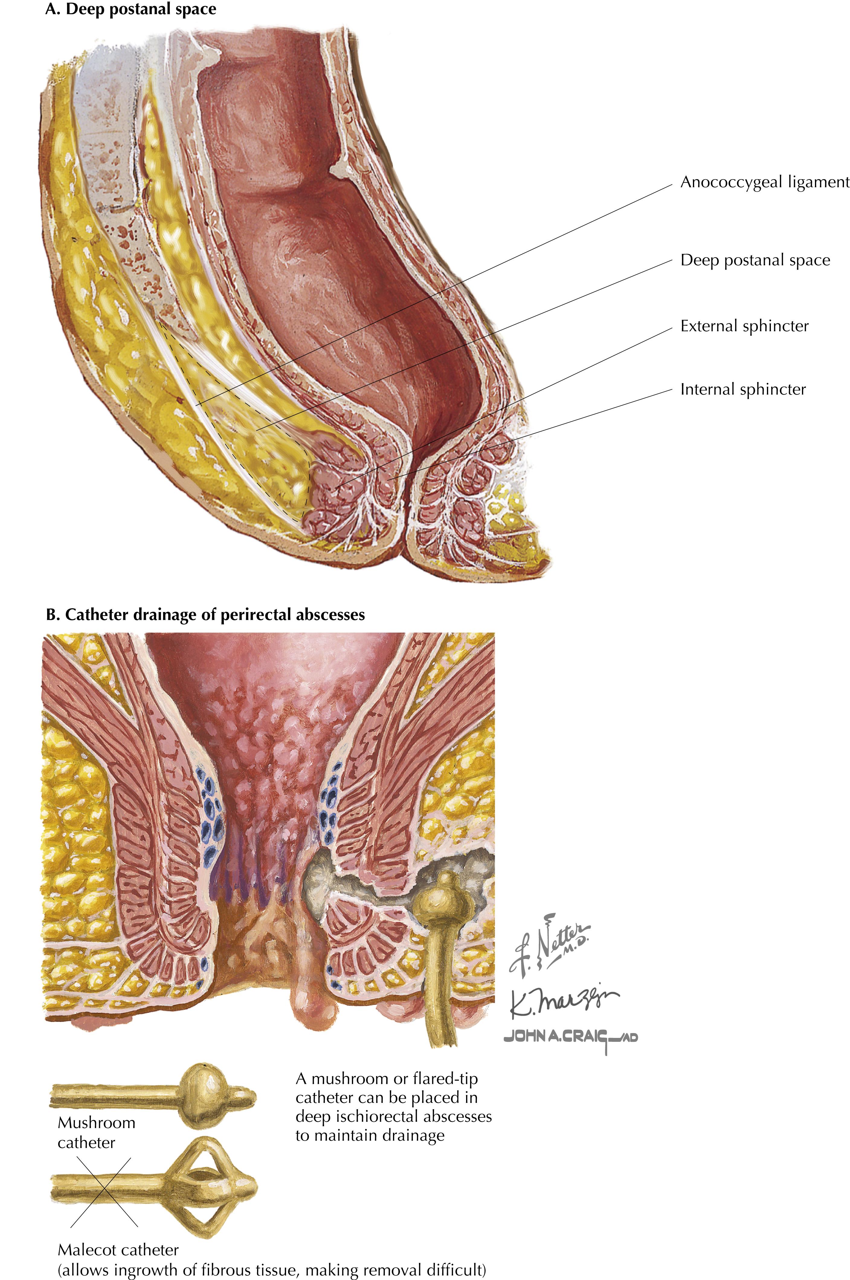 FIGURE 33.3, (A) Deep postanal space. (B) Mushroom catheter drainage of ischiorectal abscess.