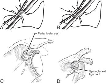 FIGURE 8.4, (A–D) Suprascapular nerve compression.