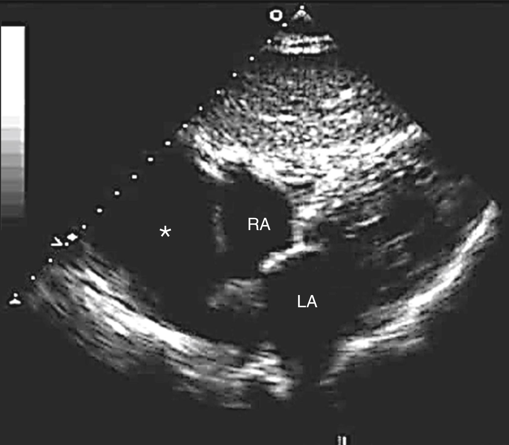 Figure 124.1, Subcostal view of a pericardial cyst (asterisk) adjacent to the right atrium (RA). Note the smooth border and that there is no compression of the RA. LA, Left atrium. (See accompanying Video 124.1 .)