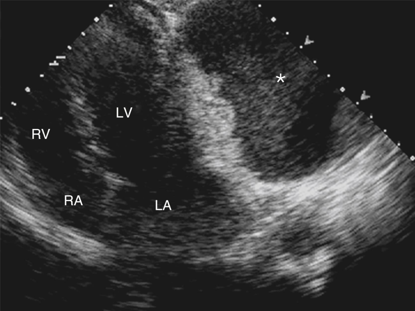 Figure 124.2, Apical four-chamber view demonstrating a giant pericardial cyst (asterisk) adjacent to the left ventricle (LV) and left atrium (LA). RA, Right atrium; RV, right ventricle. (See accompanying Video 124.2 .)