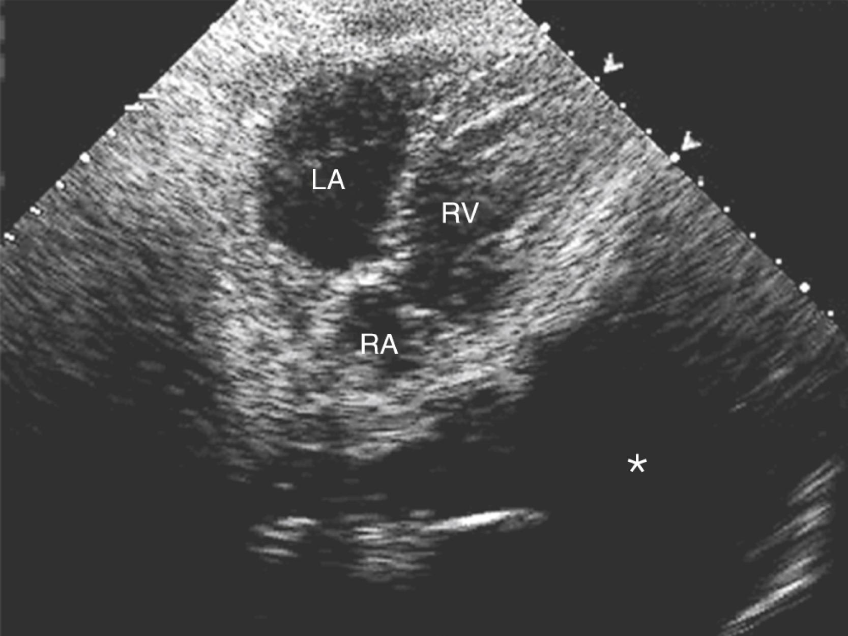 Figure 124.3, Subcostal view of the same giant pericardial cyst as in Fig. 124.2. The true enormity of the size of the cyst (asterisk) is better revealed from the subcostal view, and the decision was made to percutaneously drain the cyst. A total of 1100 mL of fluid was removed. LA, Left atrium; RA, right atrium; RV, right ventricle. (See accompanying Video 124.3 .)