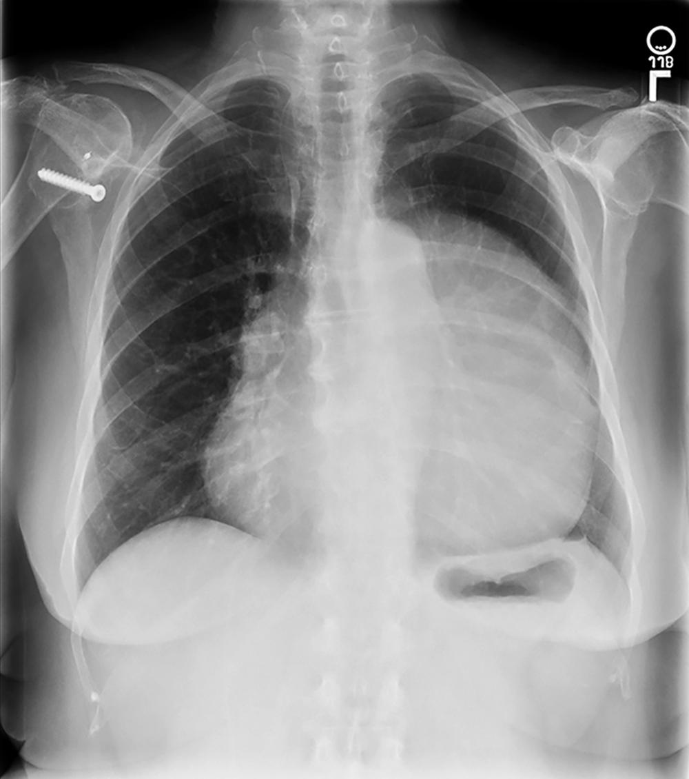 Figure 124.4, Associated chest radiography (same patient as in Fig. 124.2) demonstrating a markedly enlarged cardiac silhouette caused by the giant pericardial cyst.