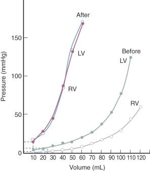 Figure 23-1, Pressure-volume curves of left and right ventricles (LV, RV) in dogs, made immediately after death by introducing 10-mL boluses of saline solution via aorta or pulmonary artery into the closed ventricle. Note that in the normal dog heart (Before), compliance of right ventricle is greater than left. In hearts of dogs with generalized pericardial constriction (After), compliance is low and similar in both ventricles.