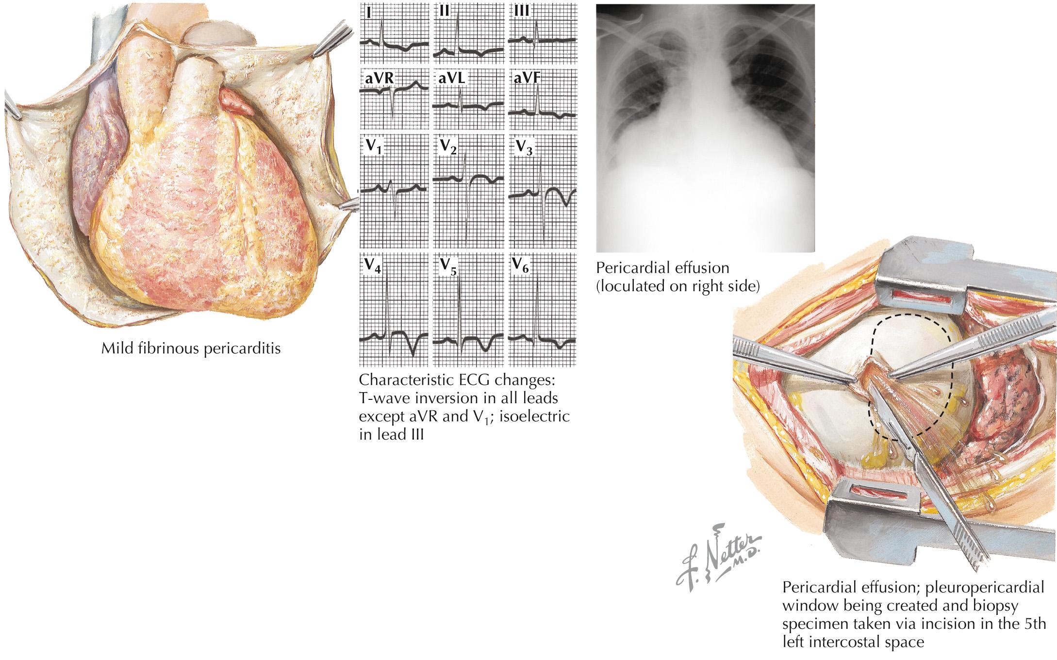 FIG 56.2, Diseases of the Pericardium: Presentation and Treatment of Pericarditis.