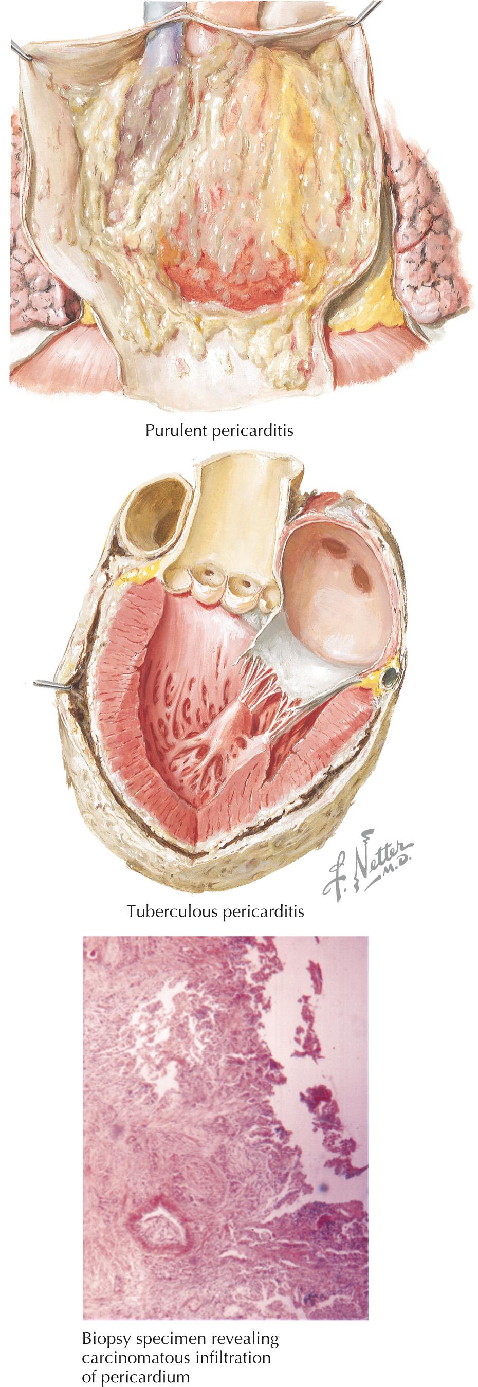 FIG 56.3, Diseases of the Pericardium: Etiologies.