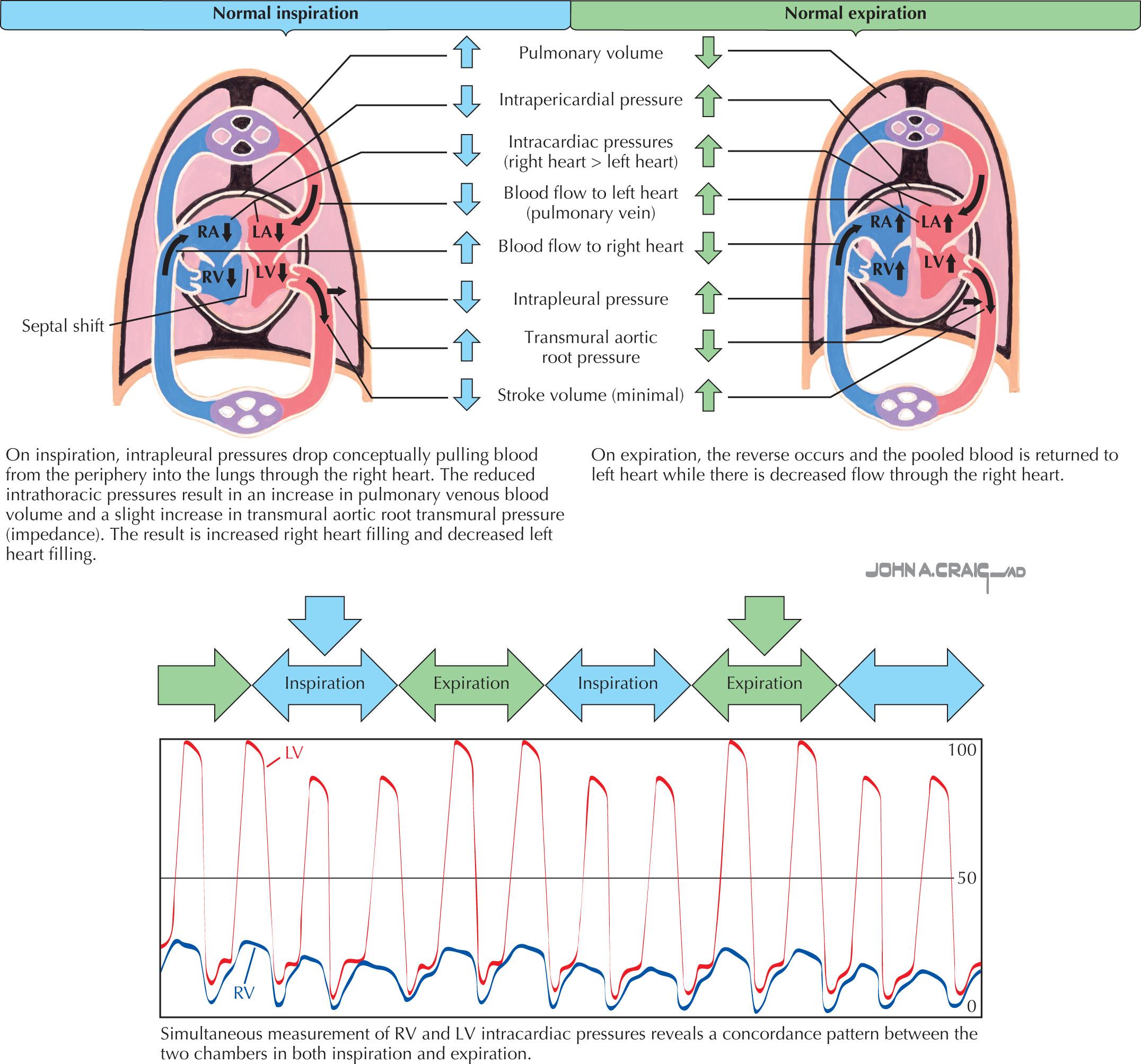 FIG 57.1, Normal Cardiac Blood Flow During Inspiration and Expiration.