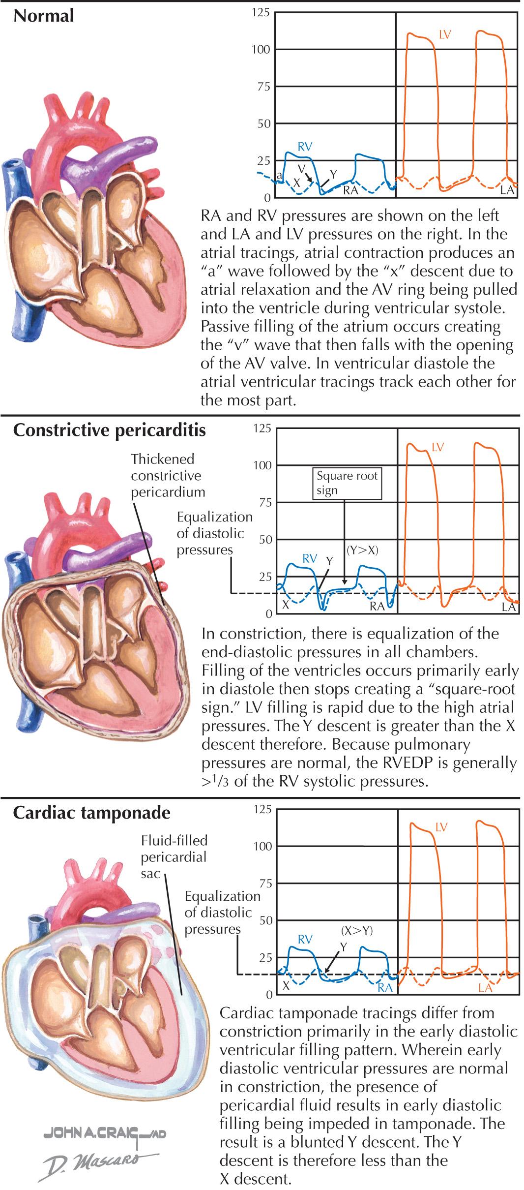 FIG 57.2, Comparison of Normal and Pathological Intracardiac Pressures.