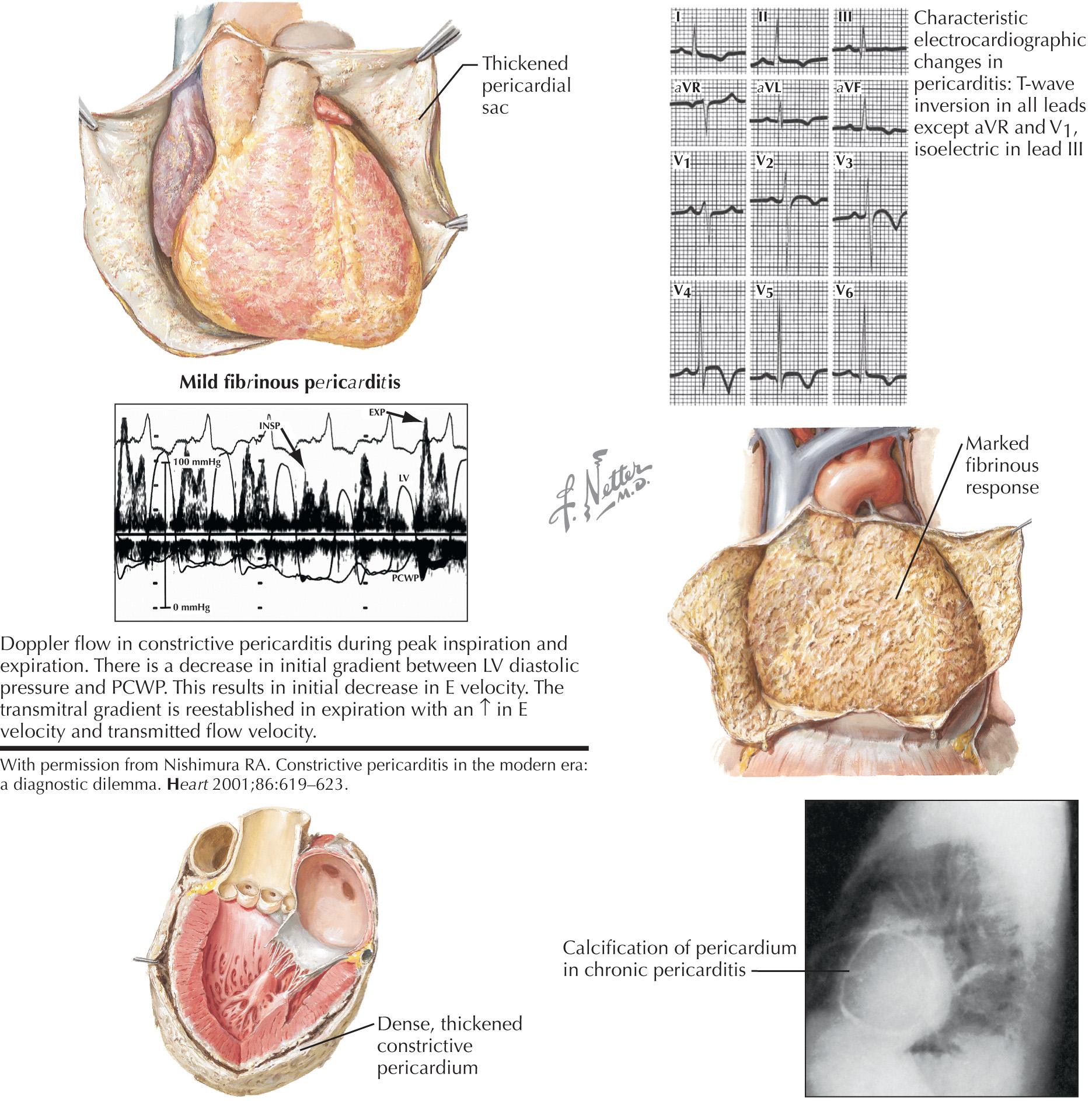 FIG 57.3, Constrictive Pericarditis.