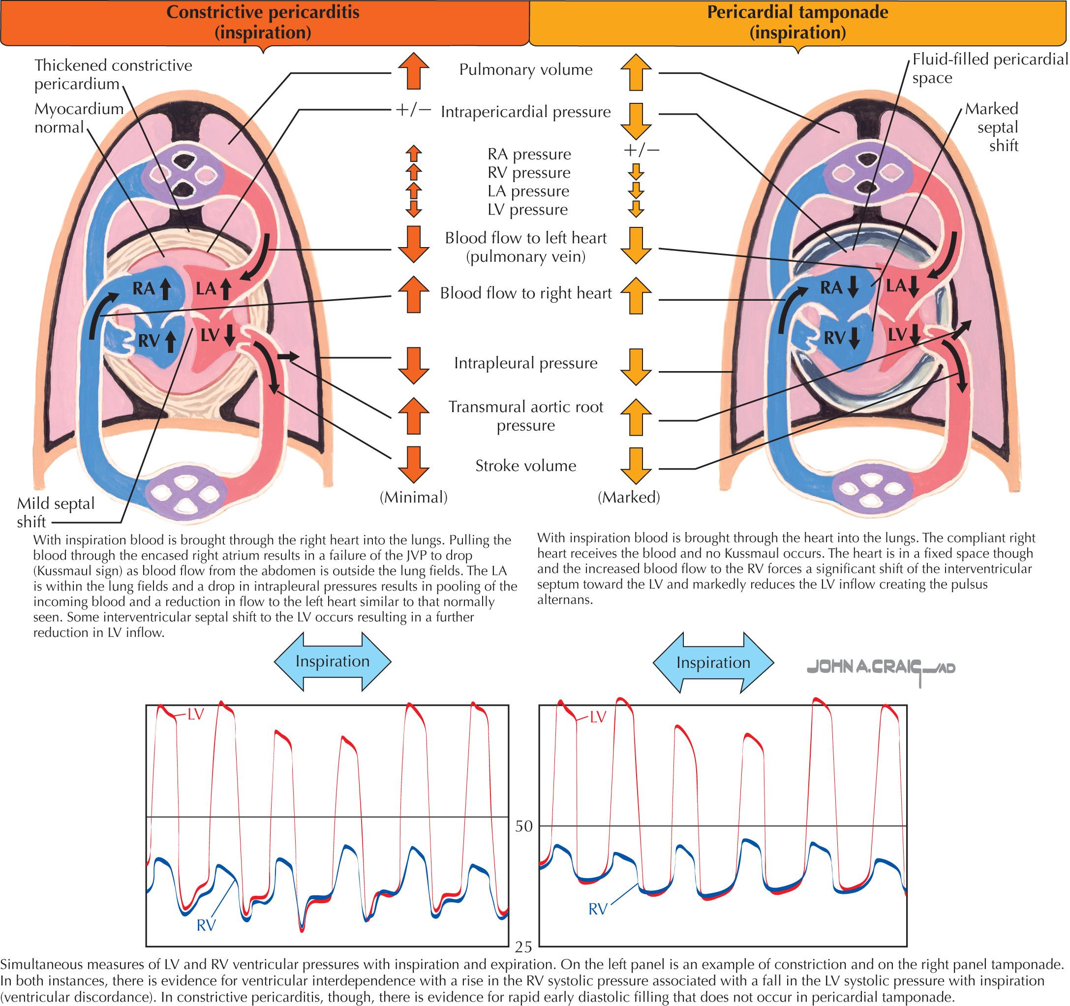 FIG 57.4, Comparison of Blood Flow in Constrictive Pericarditis and Pericardial Tamponade.