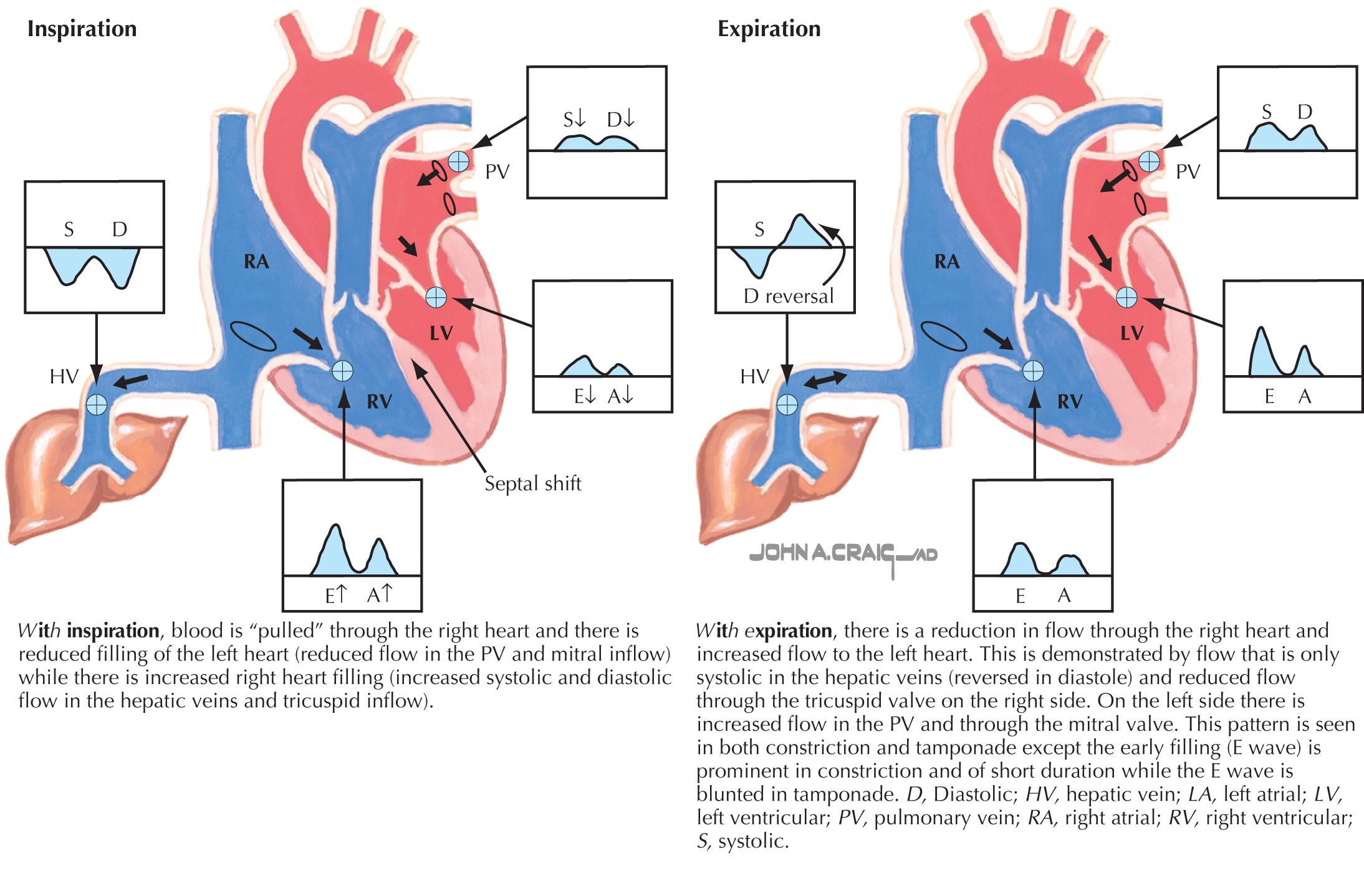 FIG 57.5, Respiratory Echo-Doppler Flow Patterns in Pericardial Disease.