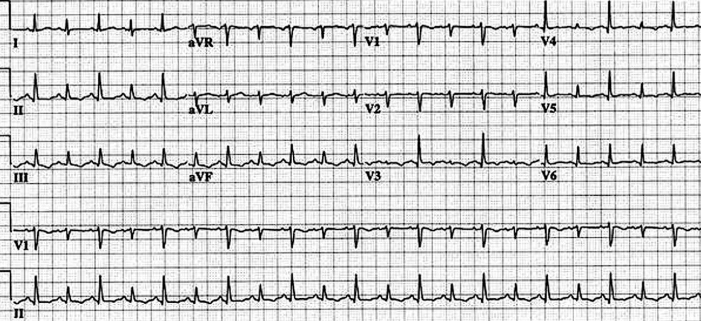 Fig. 57.3, Twelve-lead ECG from a child with large pericardial effusion showing sinus tachycardia and beat-to-beat change in QRS axis (electrical alternans).