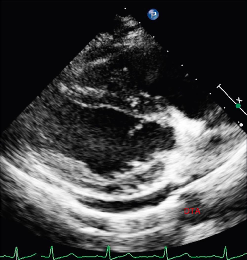 Fig. 57.4, Transthoracic echocardiogram in modified parasternal long-axis view showing mild pericardial effusion. The accumulation of fluid between cardiac chamber and descending thoracic aorta (DTA) localizes fluid to the pericardium.