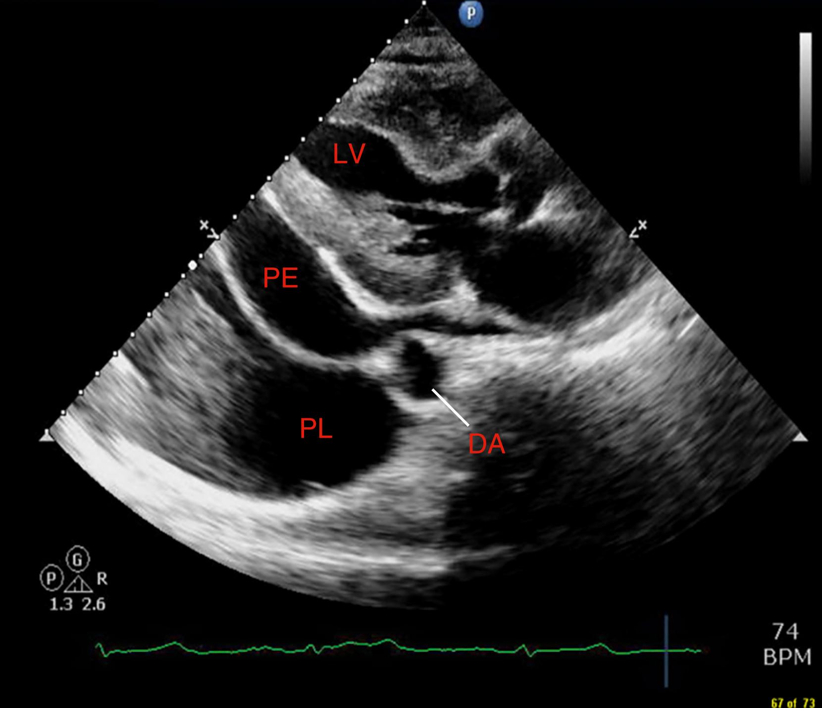 Figure 121.1, Parasternal long-axis image in a patient with both pericardial (PE) and pleural (PL) effusions. Note that the pericardial fluid lies anterior to the descending thoracic aorta (DA). The left ventricle (LV) is marked for reference.