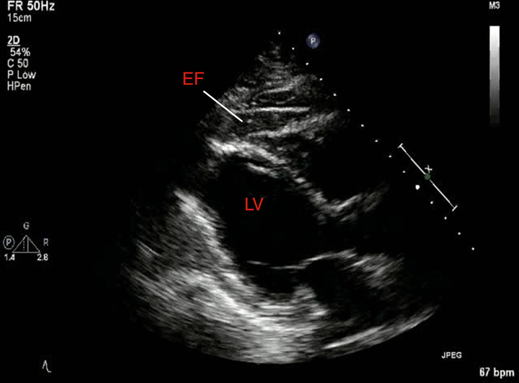 Figure 121.2, Parasternal long-axis image demonstrating anterior epicardial fat (EF). Note the typical stippled appearance of the tissue. The left ventricle (LV) is marked for reference. (See accompanying Video 121.2 .)