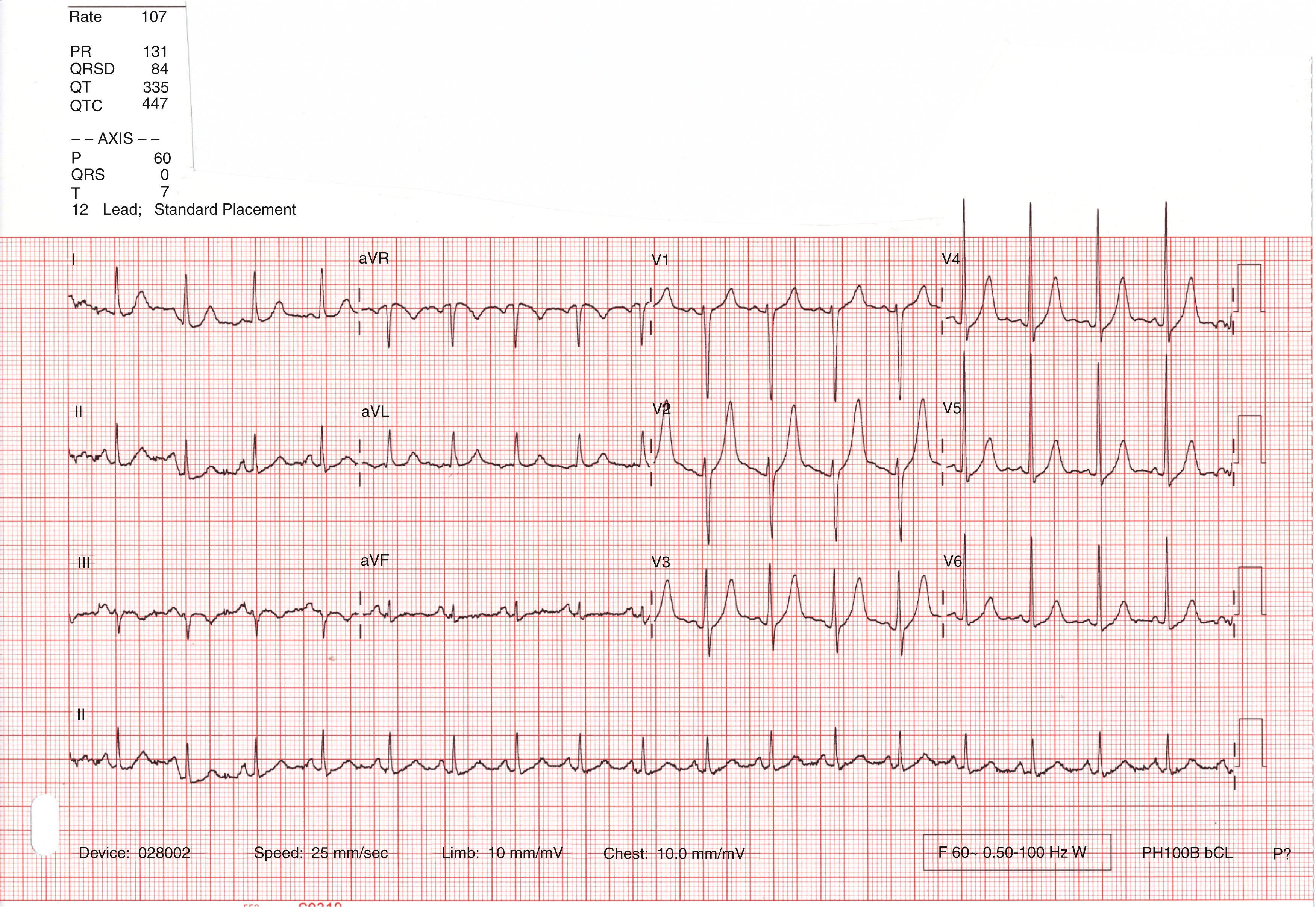 Fig. 68.2, EKG showing left ventricular hypertrophy.