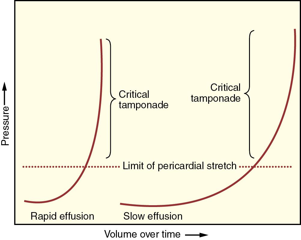 Fig. 11.2, Pericardial pressure-volume curves are shown in which the intrapericardial volume increases slowly or rapidly over time. On the left curve, rapidly increasing pericardial fluid quickly exceeds the limit of pericardial stretch, which causes a steep increase in pericardial pressure. On the right curve a slower rate of pericardial filling takes longer to exceed the limit of pericardial stretch because there is more time for the pericardium to stretch and compensatory mechanisms to become activated.
