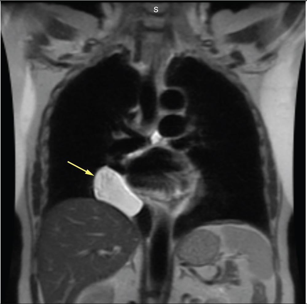 Fig. 11.4, Magnetic resonance imaging coronal plane across the chest demonstrating contrast enhancement due to a pericardial cyst (arrow) .