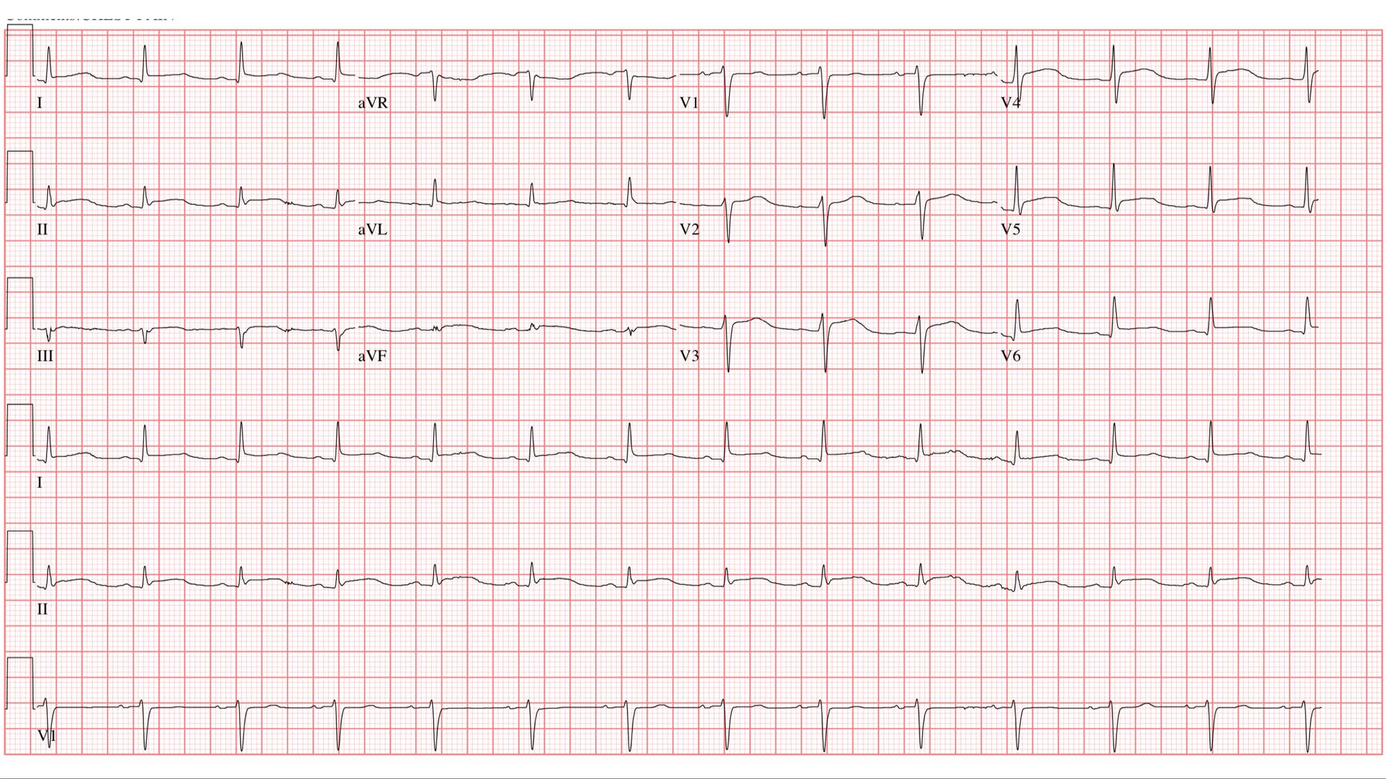 Fig. 11.5, Electrocardiogram of a patient with acute pericarditis. Diffuse ST-segment elevations and PR-segment depressions are seen.