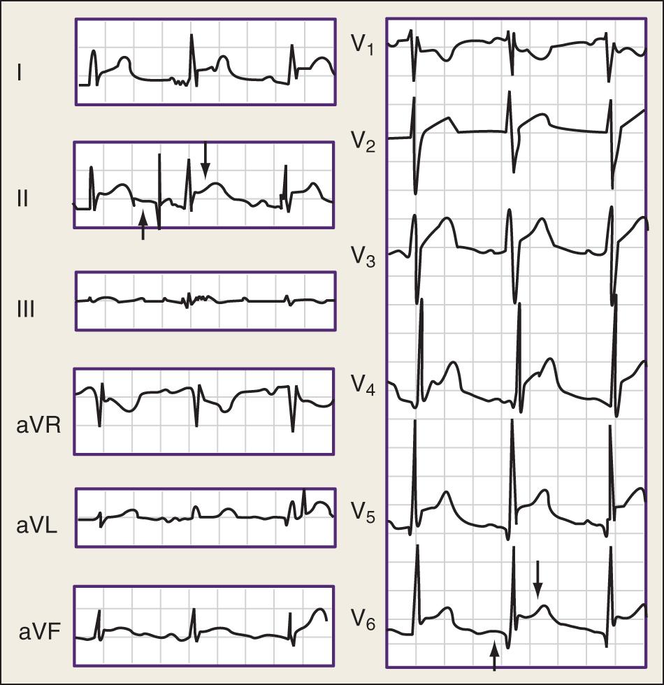 Fig. 75.1, Typical electrocardiographic changes in acute pericarditis: PR depression (small arrow) and concave ST-segment elevation (large arrow).