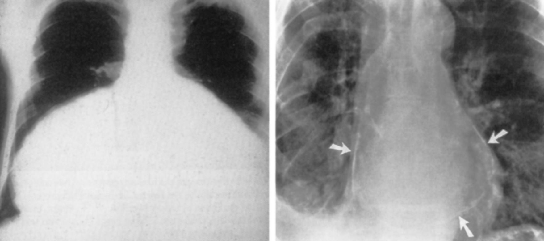 Fig. 75.2, Chest radiographs in a patient with a very large pericardial effusion—”water bottle” sign (left) —and in a patient with constrictive pericarditis and pericardial calcifications (white arrows, right).