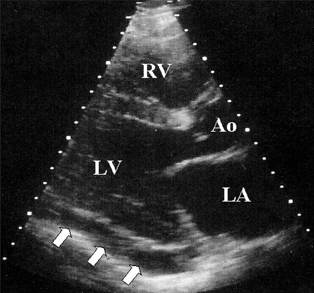 Fig. 75.3, Echocardiographic findings in a small to moderate pericardial effusion (white arrows) .