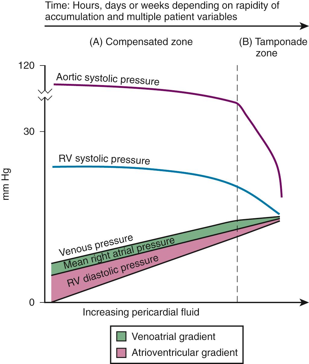 Figure 16.2, Summary of physiologic changes in tamponade. RV, Right ventricle. Note the initial slow changes, then the rapid decrease in systolic pressures once critical pericardial volume and pressure are reached.