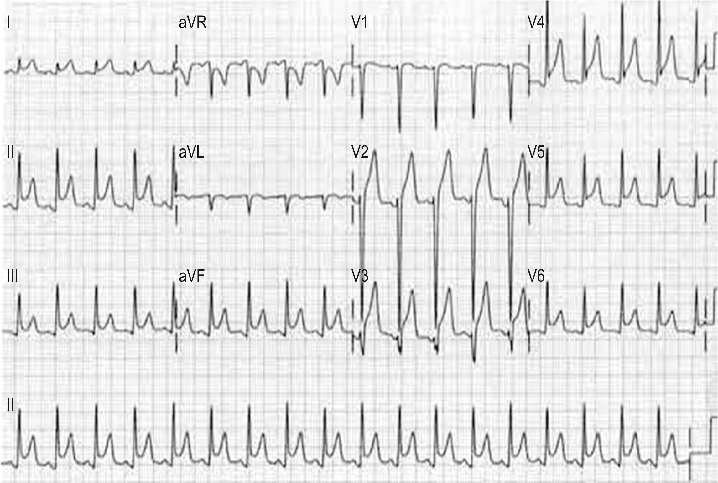 Fig. 5.6.1, Typical electrocardiogram in pericarditis.