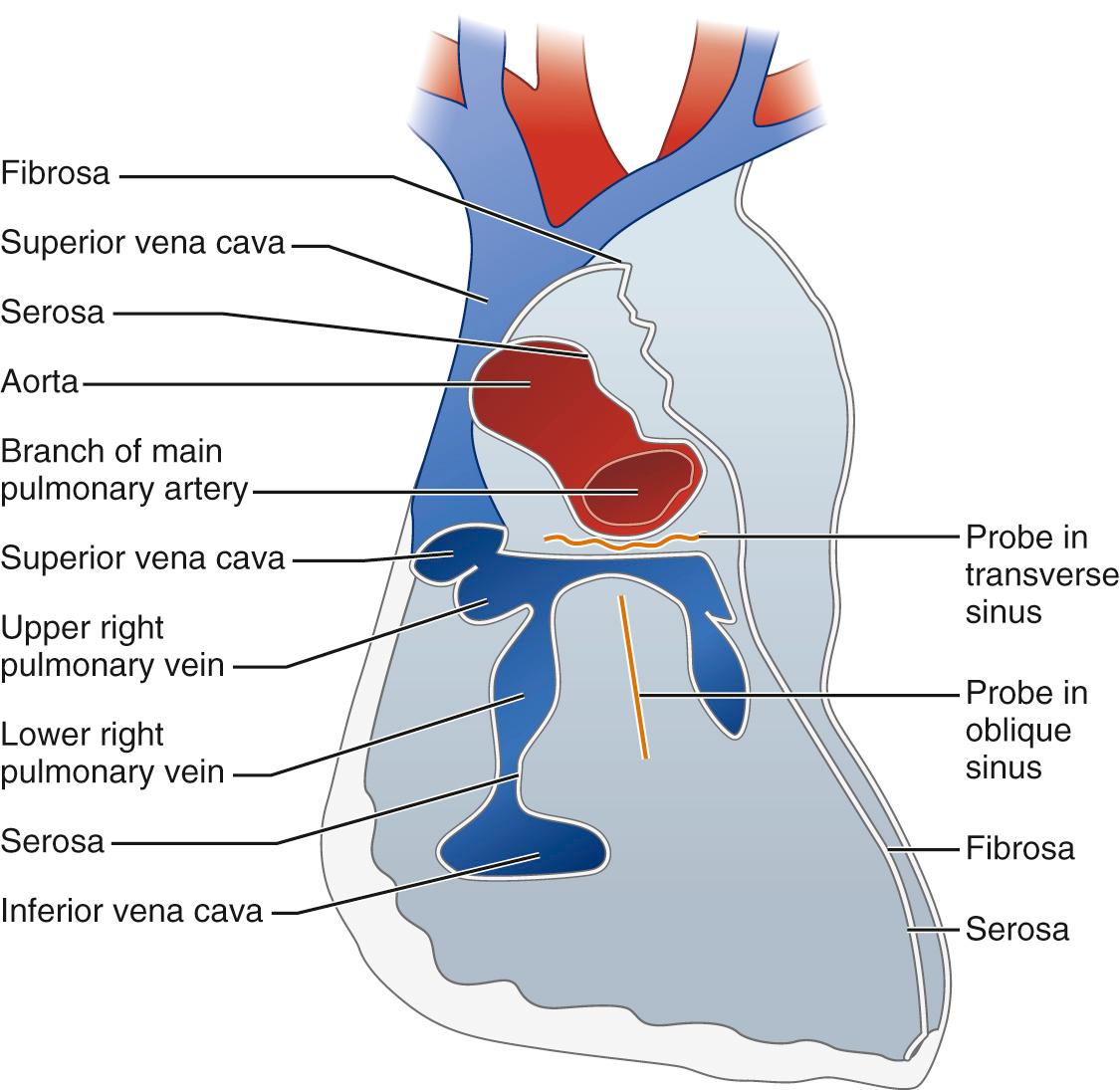 FIGURE 95-1, Anatomy of the posterior pericardial reflections. Note the transverse sinus and the oblique sinus.