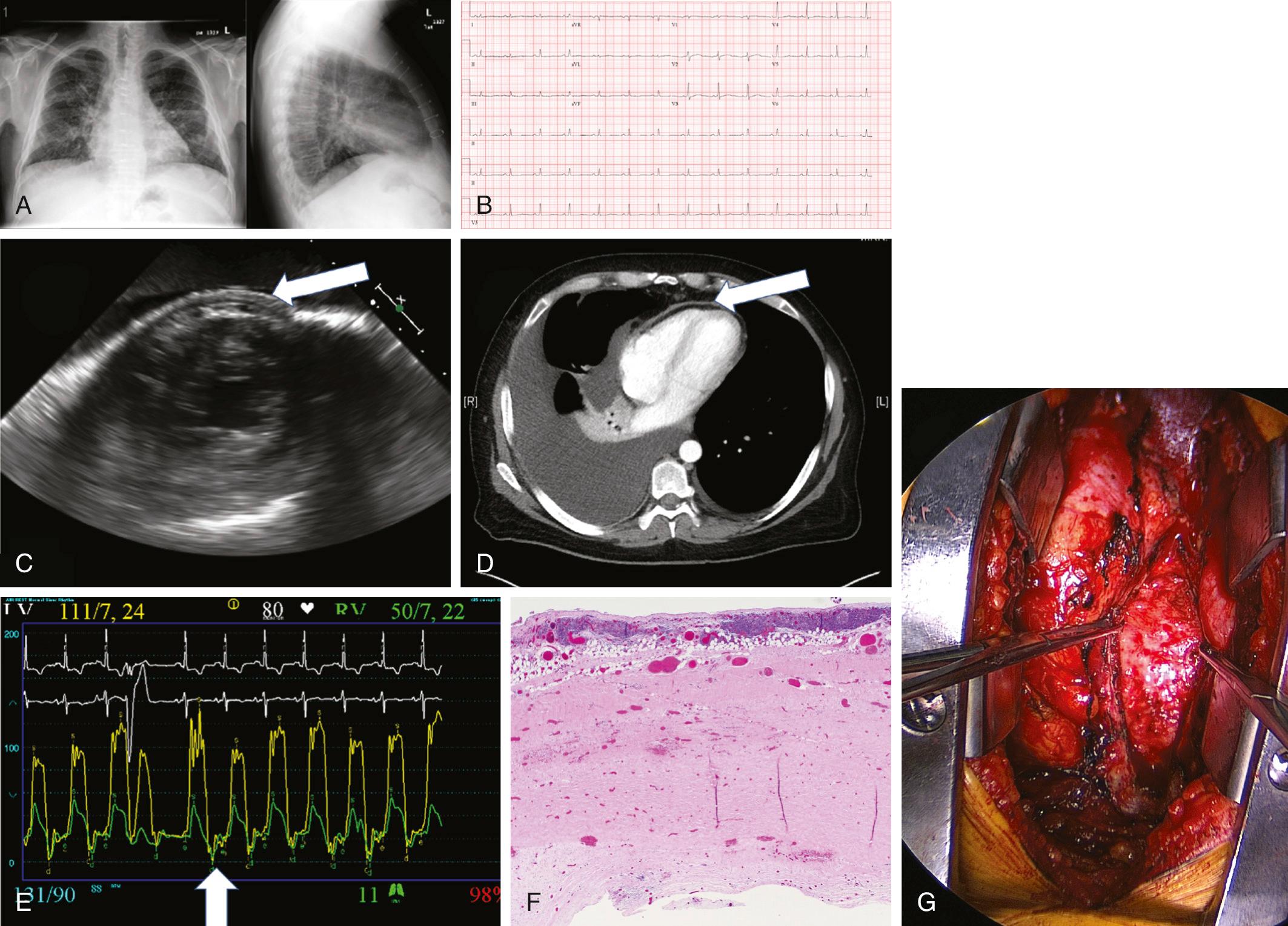 FIGURE 95-2, This patient has constrictive pericarditis. A, Chest radiograph with cardiomegaly. B, Electrocardiogram with low voltage. C, Echocardiogram with pericardial thickening (arrow). D, Computed tomographic image showing pericardial thickening (arrow). E, Simultaneous right ventricular (green) and left ventricular (yellow) pressure tracings with “square root sign” (arrow) and equalization of diastolic right and left ventricular pressures. F, Histology of resected pericardium with marked fibrous thickening and inflammation of the parietal surface (top of picture) . G, Intraoperative finding of thickened pericardium grasped in clamps.