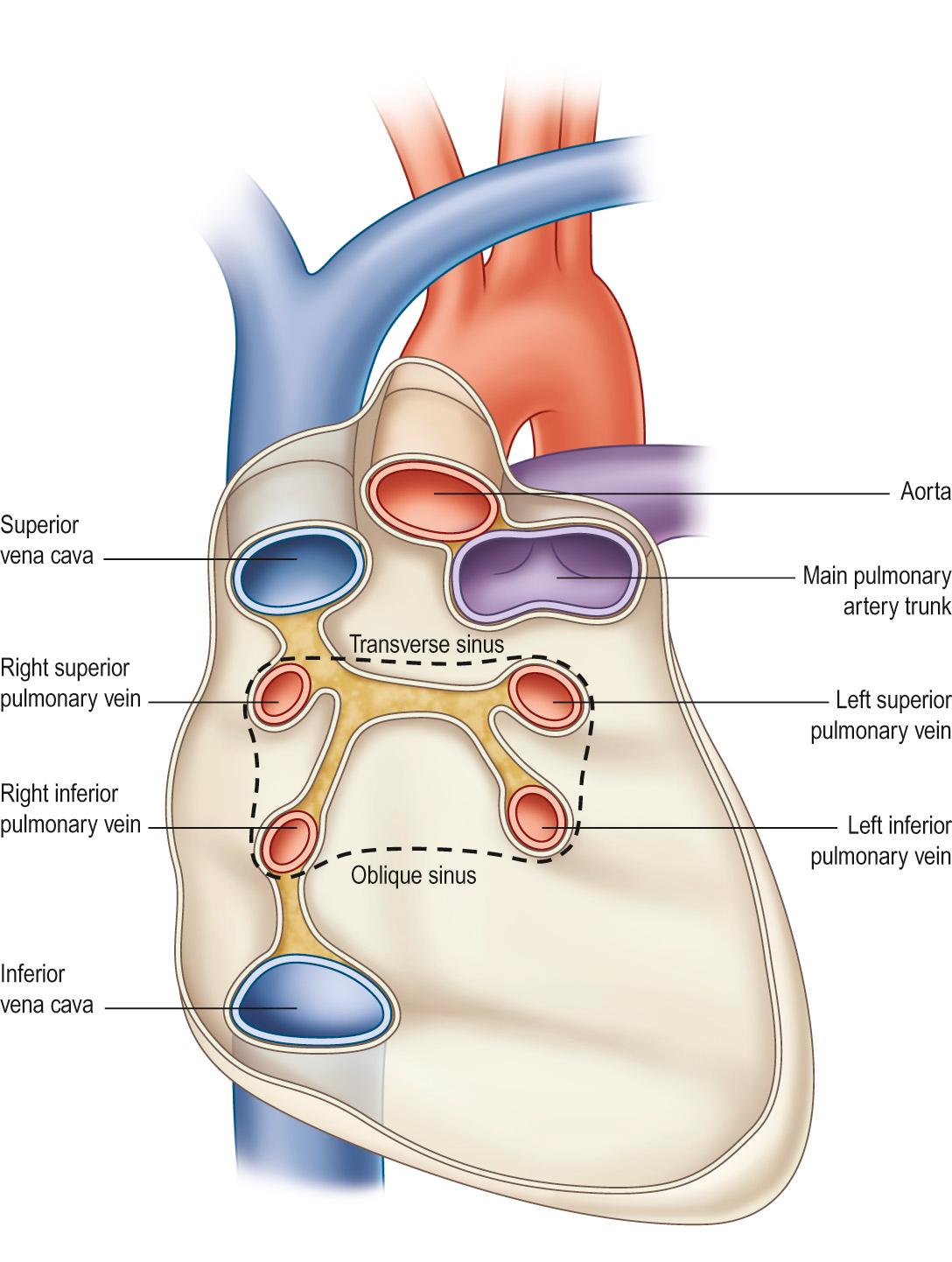 Fig. 49.1, The posterior pericardium with the heart removed and great vessels sectioned. The oblique and transverse sinuses and their boundaries are illustrated. The dashed line demonstrates the lines of ablation when typically forming a box lesion during arrhythmia surgery.