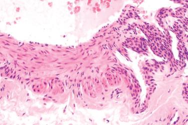 Fig. 3, Glomangiomyoma.