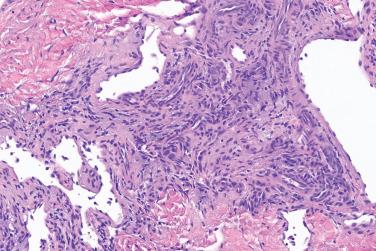 Fig. 1, Symplastic glomus tumor.