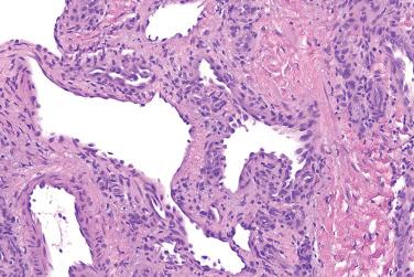 Fig. 3, Symplastic glomus tumor.