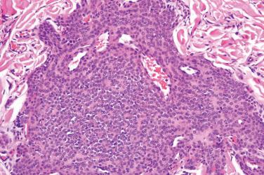 Fig. 3, Classical (solid) glomus tumor.