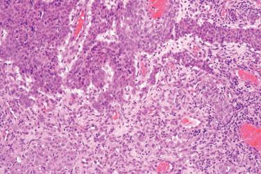 Fig. 4, Classical (solid) glomus tumor.